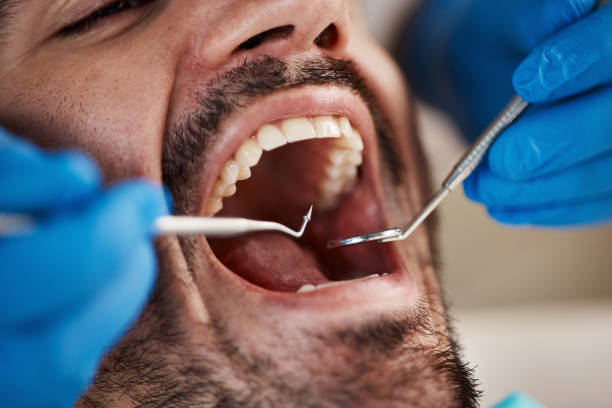 Best Emergency Dental Care for Abscessed Tooth in Washgton, IN
